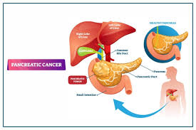 पैंक्रियाटिक कैंसर एक गंभीर बीमारी है :जाने पैंक्रियाटिक कैंसर का निदान और परीक्षण